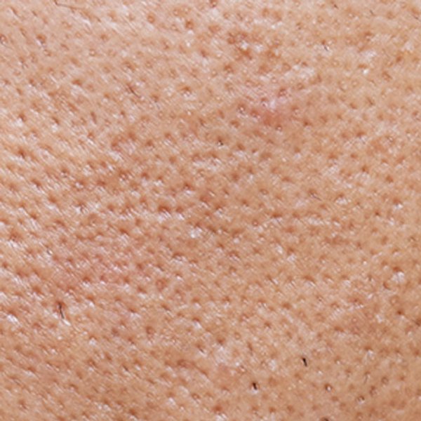 Articolo pelle a tendenza acneica - immagine principale