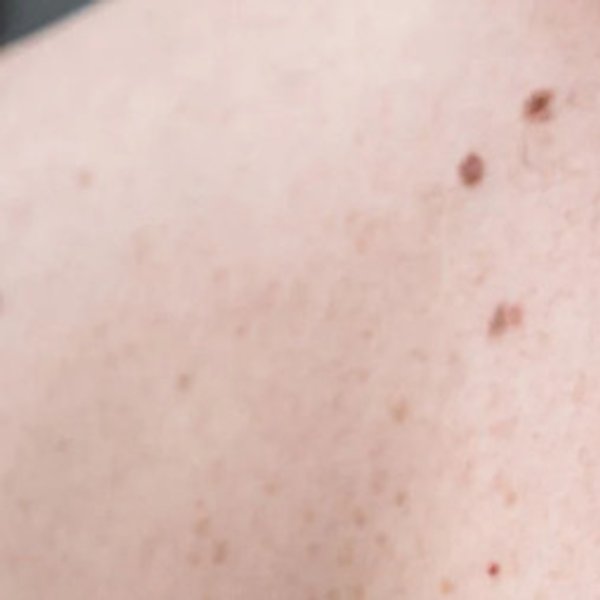 Prodotti Cosmetici Pazienti Oncologici: Quali Usare | La Roche Posay