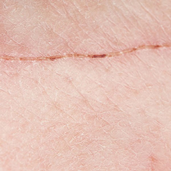 Articolo pelle a tendenza acneica - immagine principale