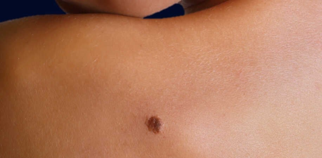 Esposizione al sole e melanoma: come prevenirlo