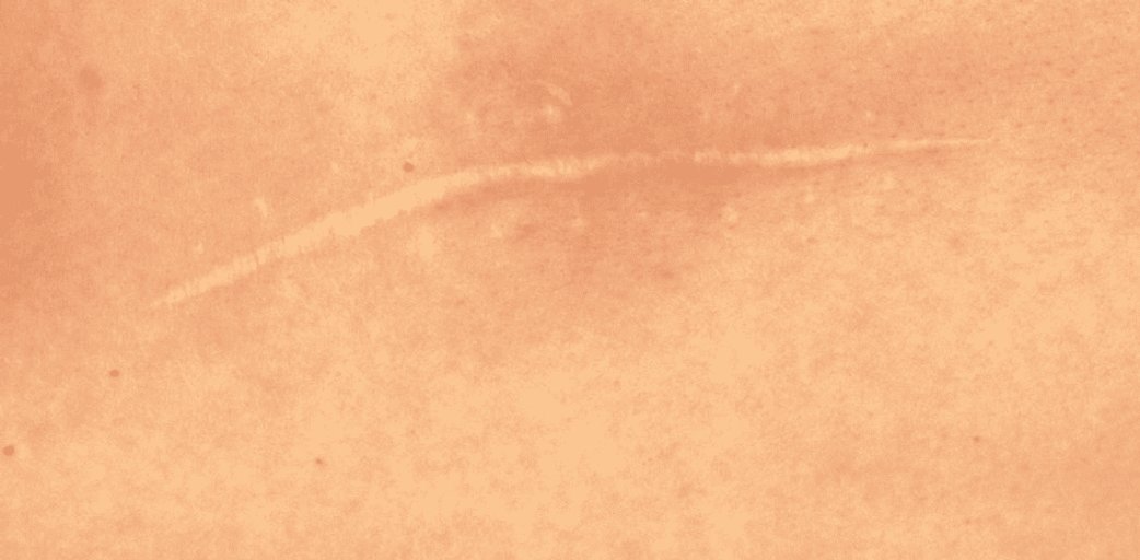 Trattamento delle Cicatrici Chiuse: Cosa Fare? | La Roche Posay