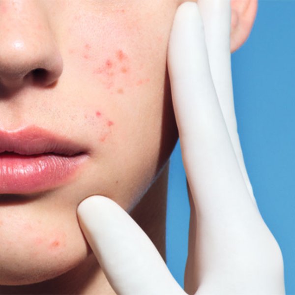 Larocheposay-SubCategoryPage-Acne-What-causes-oily-acne-prone-skin-how-to-prevent-it