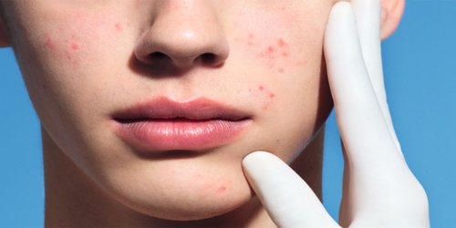 Risultati di una pelle acneica e grassa: cause e prevenzione